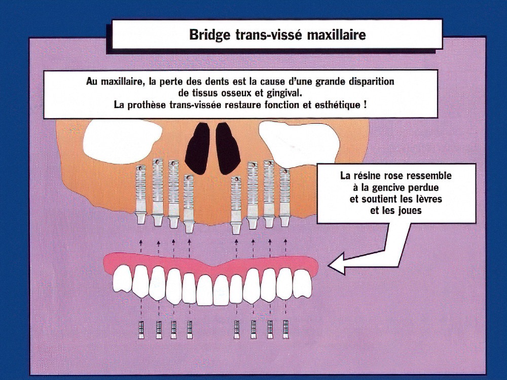Bridge transvissé maxillaire sur implants Strasbourg